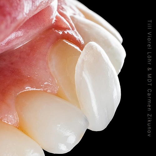 Try Fitting Ultra-thin veneers – as delicate as a contact lens! Minimally invasive but maximum outcome! The best part:...
