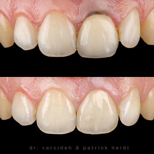 Single crown : gum transplant to get more thickness and idealise the form of the gingiva in combination with nice...