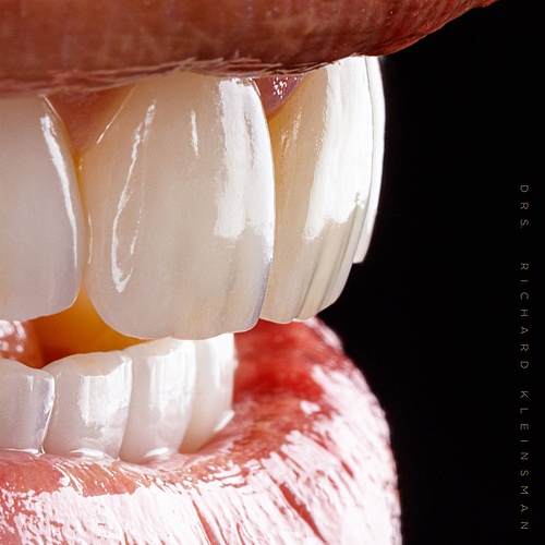 Handmade natural veneers! . . Dentist: @drs.richardkleinsman Technician: @mike_richterbl . . 📸:...