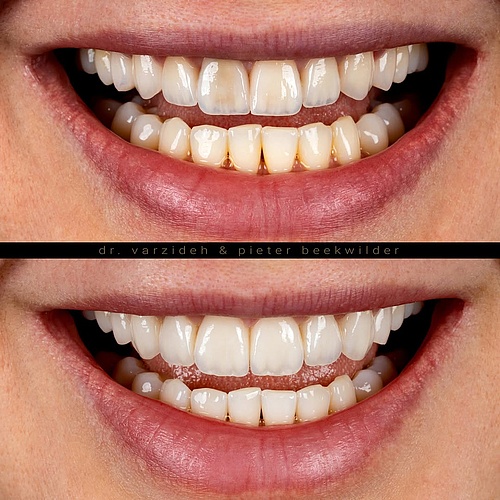 Transforming the smile with natural-looking ceramic veneers. Designed for harmony, brightness, and a confident smile. ....
