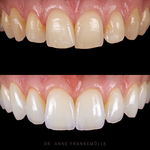 Having veneers without showing that you have them. Beautiful case with 10 almost prepless veneers. . . Dentist:...