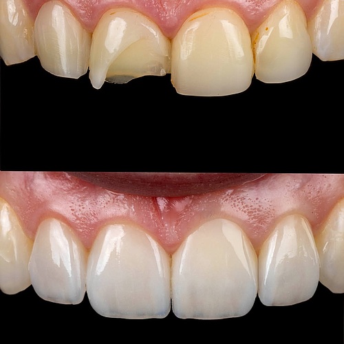 Non-prep veneers are often perceived as straightforward. Minimal intervention, minimal risk. Yet in reality, they... Non-prep veneers are often perceived as straightforward. Minimal intervention, minimal risk. Yet in reality, they...