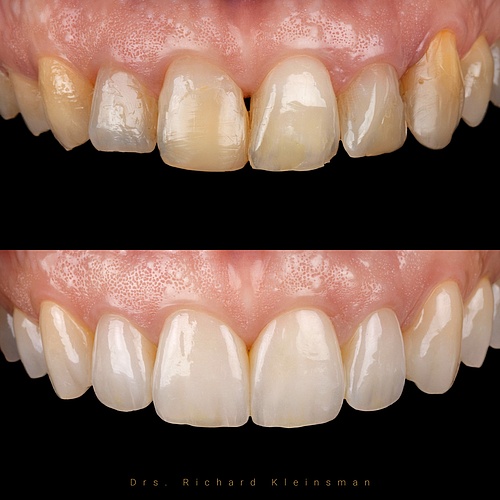 12 very thin (0,3-0,5 mm) non - prep veneers for a new natural smile! . . Dentist: @drs.richardkleinsman Technician:...