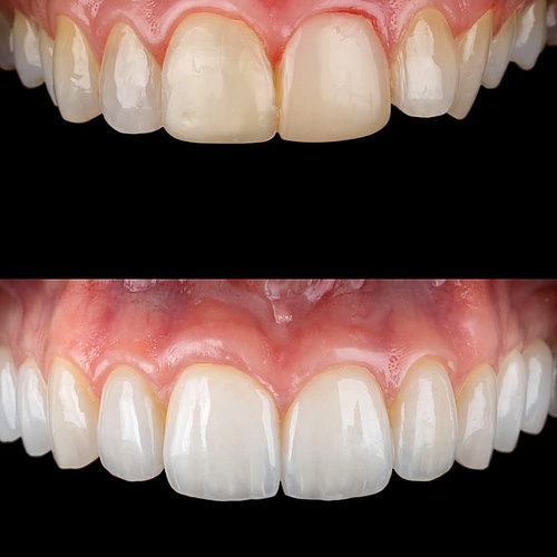 Transforming smiles step by step! We removed old composite veneers and replaced them with handcrafted porcelain veneers...
