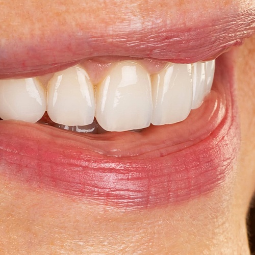 BITE LIFT | GINGIVAL HARMONIZATION | CERAMIC VENEERS & CROWNS Balanced. Natural. (@annefrankemolle) . . Dentist:... BITE LIFT | GINGIVAL HARMONIZATION | CERAMIC VENEERS & CROWNS Balanced. Natural. (@annefrankemolle) . . Dentist:...
