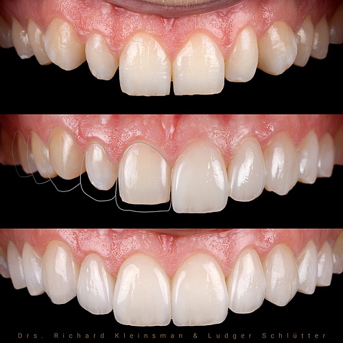 10 very thin handmade non - prep veneers (0,4mm) for a new natural smile! . . Dentist: @drs.richardkleinsman ...
