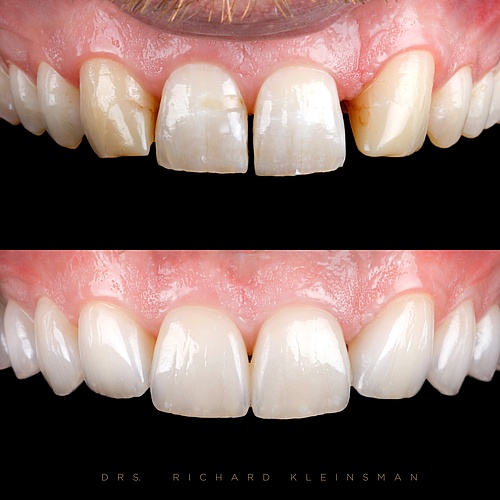 Non prep veneers from 16-26 to create more harmony. For this result the canines were transformed into laterals and the...