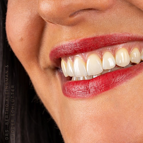 Non-prep veneers made this stunning smile possible — no drilling, no pain, just pure aesthetic perfection. Because when...