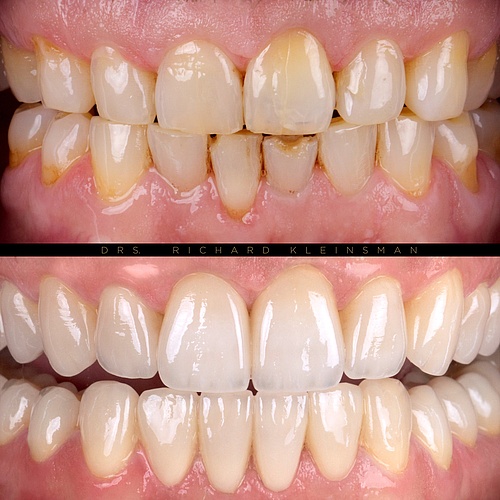 Natural renovation with 14 crowns and 14 veneers! . . Dentist: @drs.richardkleinsman Technician: @mdt.t.weiler . . 📸:...