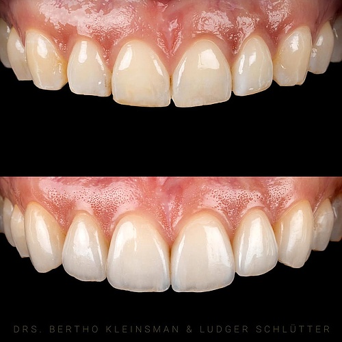 Here you can see 6 non-prep veneers. This method does not damage your own tooth. Take a look at the beautiful result. •...