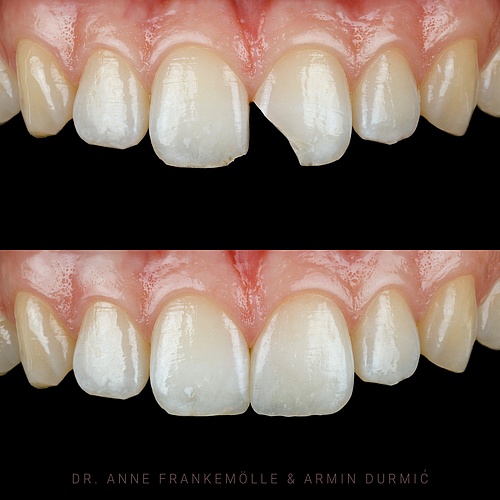 Anterior tooth trauma⚡️ The aim is to restore the original beauty of the tooth. (@annefrankemolle) . Check out the...