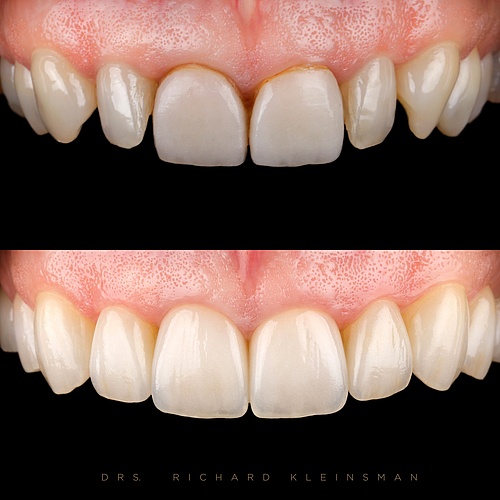 Changed the color and form, 2 new crowns and 8 veneers. . . Dentist: @drs.richardkleinsman Technician:...