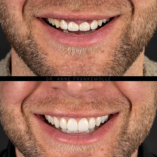 Aesthetics follow biology. This patient presented with four anterior crowns following a series of failed veneer... Aesthetics follow biology. This patient presented with four anterior crowns following a series of failed veneer...