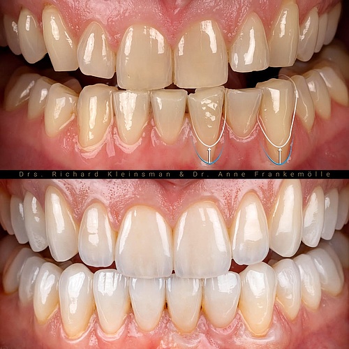 The art of a natural, powerful smile! A complete smile and facial enhancement with a minimally invasive approach –...