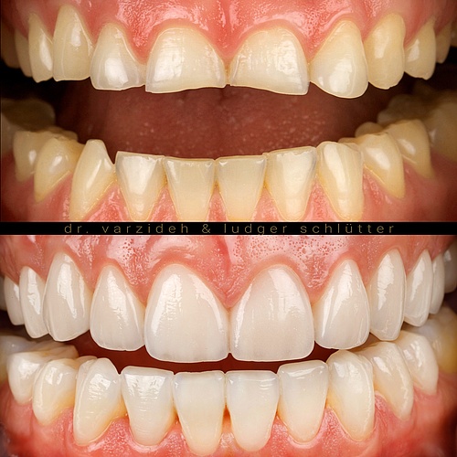 Close up - complete makeover with gum and bone correction, increasing bite height and placing veneers. . . Dentist:...