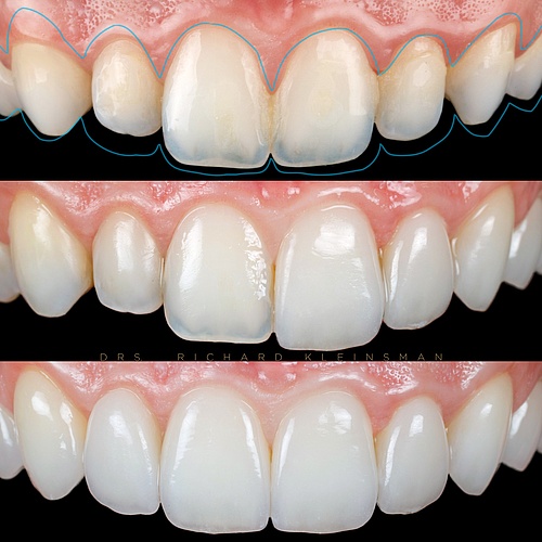 Natural renovation with non-prep veneers to create a full and magic smile after gummy - smile correction....