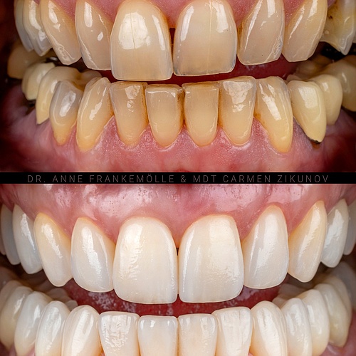 Upper and lower, united in harmony.
Veneers, crowns and implants. (@annefrankemolle)
.
.
Dentist: @annefrankemolle... Upper and lower, united in harmony.
Veneers, crowns and implants. (@annefrankemolle)
.
.
Dentist: @annefrankemolle...