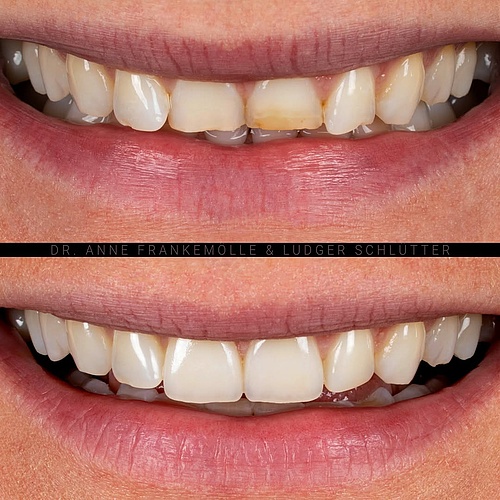 Precise contouring of the gingival margins in mesial and distal areas of the centrals enhanced the natural emergence...