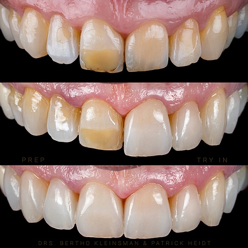 Teeth from a 53 year old woman We have not damaged the teeth zo prepared the veneers And changed her Look with some more...