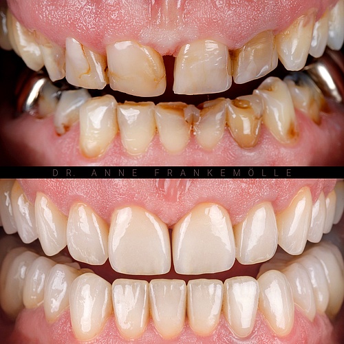 Return to a strong, natural smile! Ceramic crowns combined with a small gum lift not only improve the color and shape,...