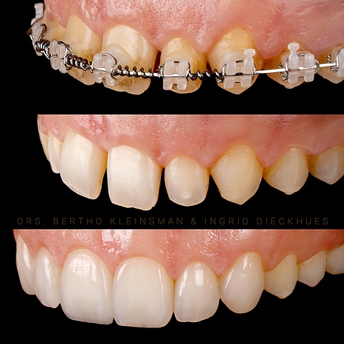Orthodontics before / veneers later . . Dentist: @berthokleinsman Technician: @ingriddieckhues . . 📸:...