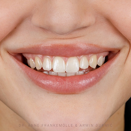Anterior tooth trauma⚡️ The aim is to restore the original beauty of the tooth. (@annefrankemolle) . Check out the...