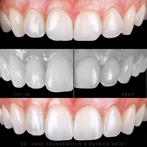 Decent upgrade to a more elegant smile. . . Dentist: @annefrankemolle Technician: @patrick.heidt . . 📸:...