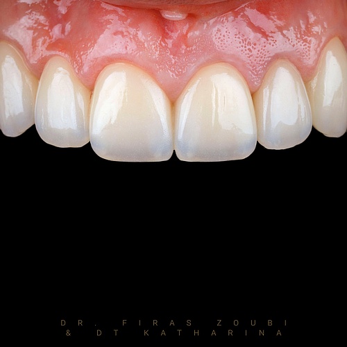 This is emotional dentistry. It is hard to grasp the impact a new smile has. The new positive radiance will not only...