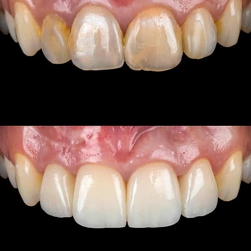 After the extraction of tooth 21, a bridge and pontic soft-tissue graft were placed — leaving no visible signs of the...