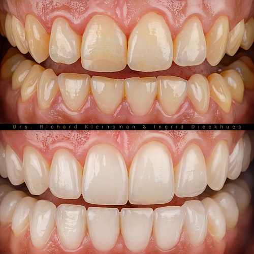 Lifted the lower jaw (6 veneers with 8 facelays) in combination with 12 non-prep veneers in the upper jaw. The total...