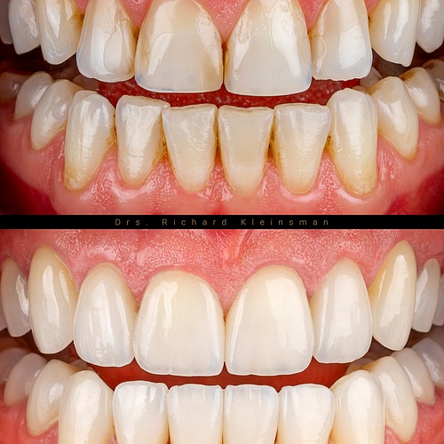 FULL-MOUTH RESTORATION | BITE LIFT | VENEERS & FACELAYS
A complete aesthetic and functional rehabilitation, combining a... FULL-MOUTH RESTORATION | BITE LIFT | VENEERS & FACELAYS
A complete aesthetic and functional rehabilitation, combining a...